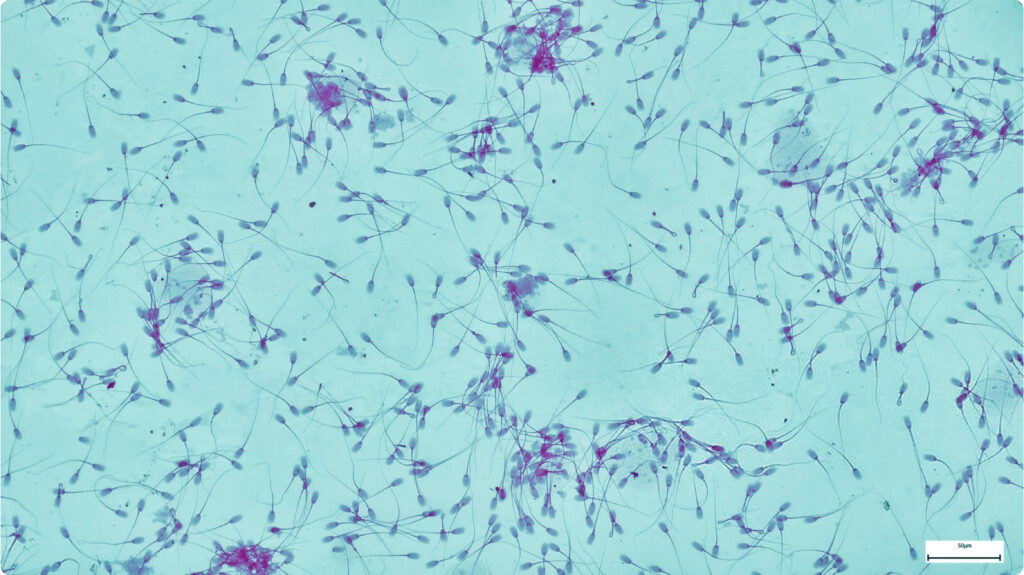 Tinh trùng màu gì thì bị vô sinh