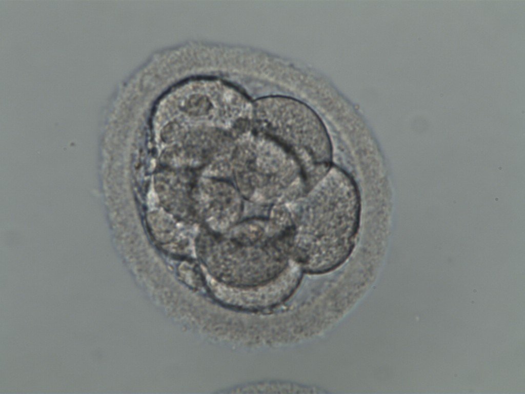 Ai nên thực hiện sàng lọc phôi IVF?