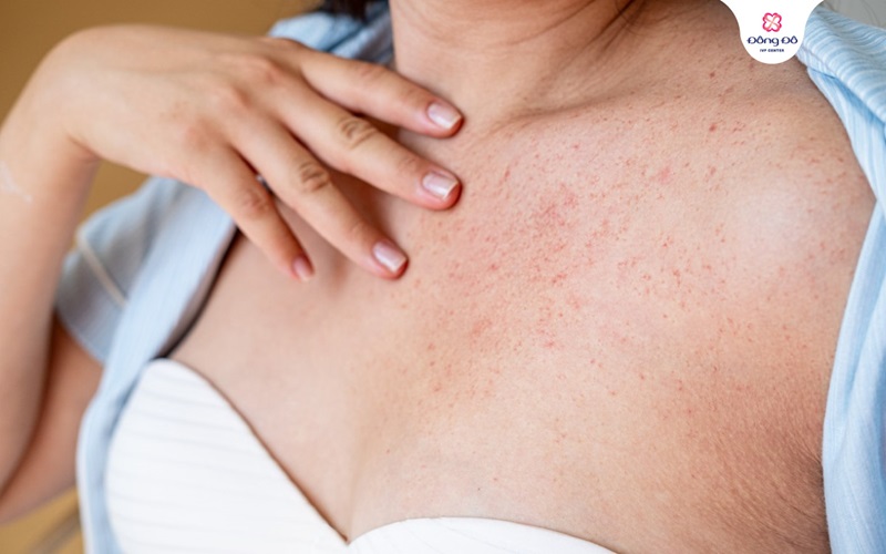 Mẩn ngứa thai kỳ (PUPPP) là gì?