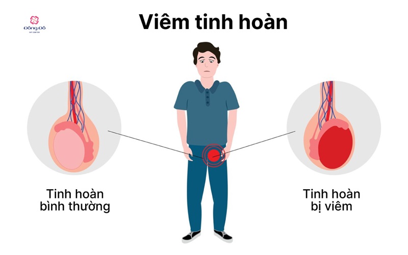 Viêm tinh hoàn, viêm buồng trứng