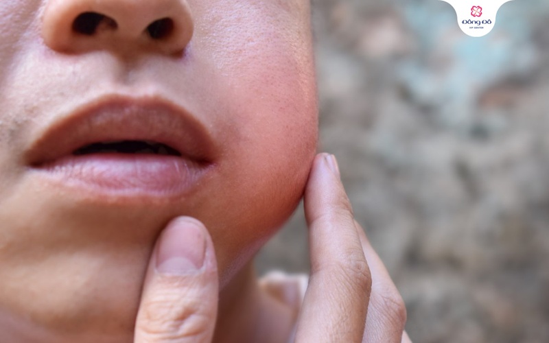 Tìm hiểu tổng quan về quai bị