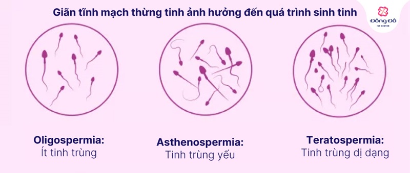 Chỉ định phẫu thuật giãn tĩnh mạch thừng tinh