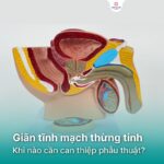 Giãn tĩnh mạch thừng tinh