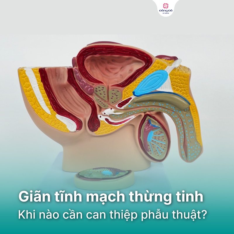 Giãn tĩnh mạch thừng tinh