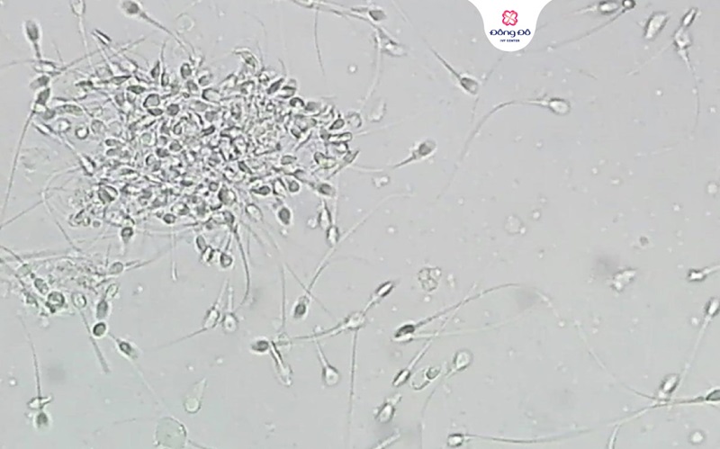 Tinh trùng vón cục là gì?