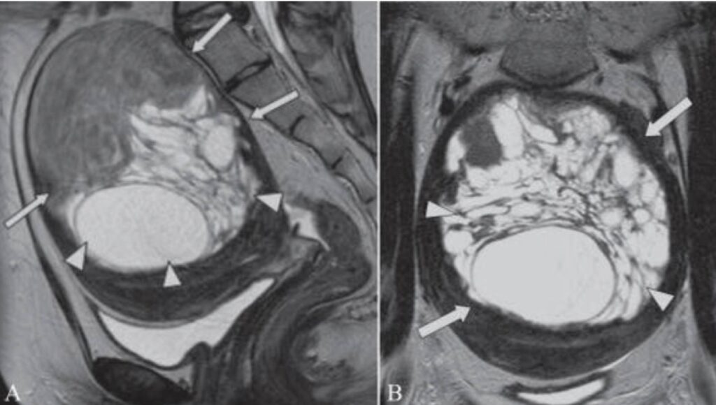 Hình ảnh siêu âm bệnh nhân rong kinh