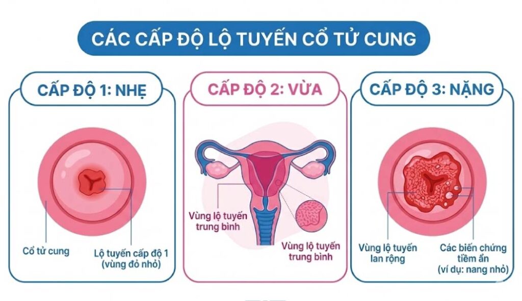 viêm lộ tuyến cổ tử cung (2)